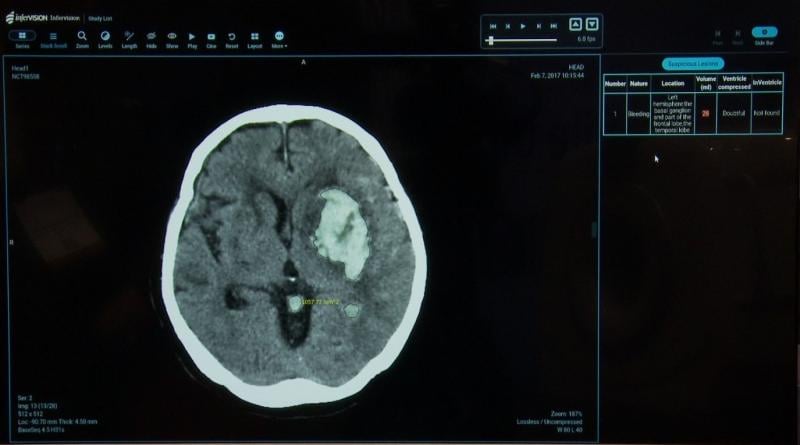 The AI smart algorithm onboard the Infervision stroke product calculates the volume of bleed on the basis of multiple brain CT slices. The size of the bleed volume indicates the urgency and type of treatment required.