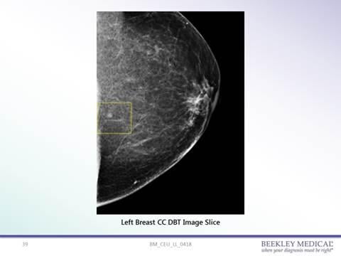 62-year-old female patient presenting for 3D screening mammogram. Location of an indeterminate low-density circumscribed mass was not clearly determined as at the skin line or just under the surface.