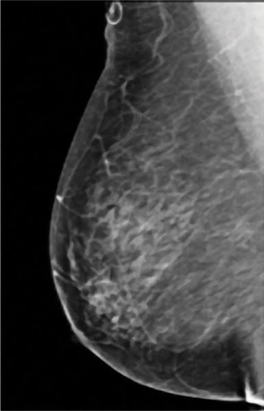 fibroglandular density, dense breasts, dense breast tissue