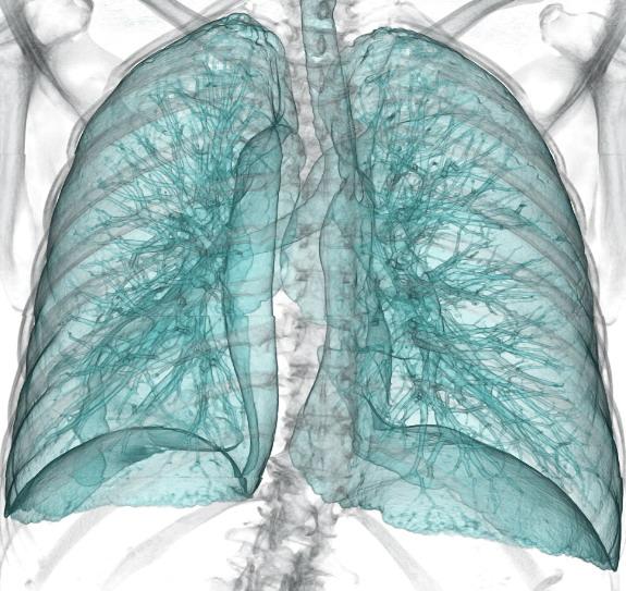 Lung Cancer CT Screening American College of Radiology