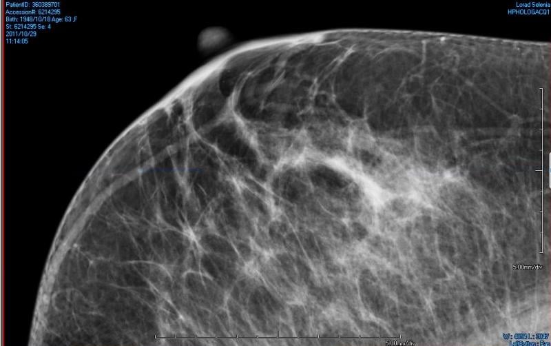 Breast Density Reporting Advances on National and State Levels