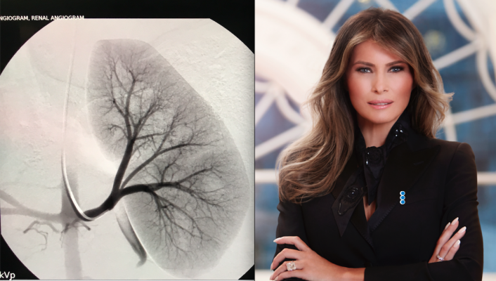 First Lady Melania Trump recently underwent an interventional radiology (IR) catheter embolization procedure in her kidneys. Also shown is an example of a kidney angiogram to highlight the renal blood vessels during an interventional procedure.