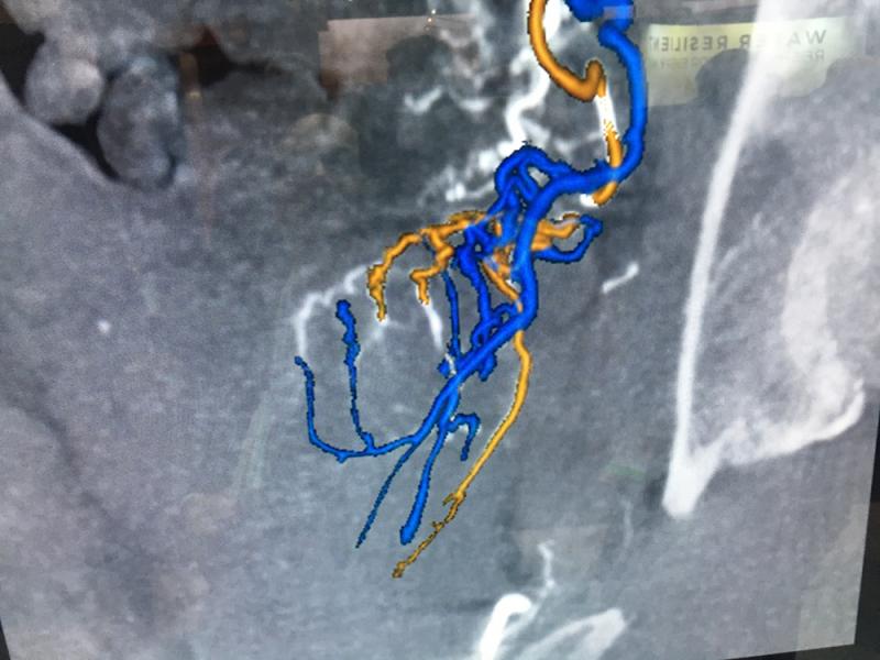 GE Healthcare's Neuo Assist artificial intelligence app, which automates image reconstruction and shows the interventional neurologist the optimal vascular access route to stoke. This has the potential to speed procedures in the cath lab.
