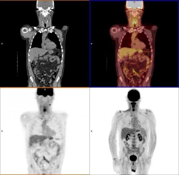 A PET/CT head and neck cancer scan.