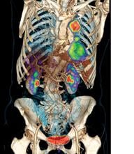 PET/CT scanners allow for precise anatomic localization of molecular data and simultaneous anatomic evaluation in a single exam. Depicted here is lung cancer. (Photo courtesy of Siemens Healthcare)