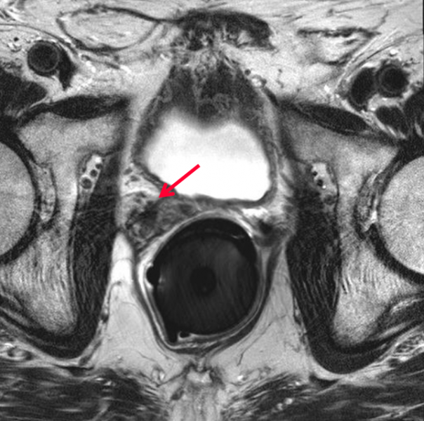 The arrow in this image points to the prostate cancer.