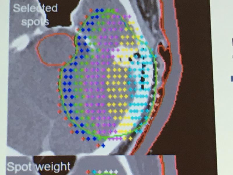 An example of a pencil beam proton therapy treatment plan for a brain tumor. Each dot is a pencil beam location for proton energy deposition in the tumor. The colors represent the dose delivered. #ASTRO2018 #ASTRO #ASTRO18