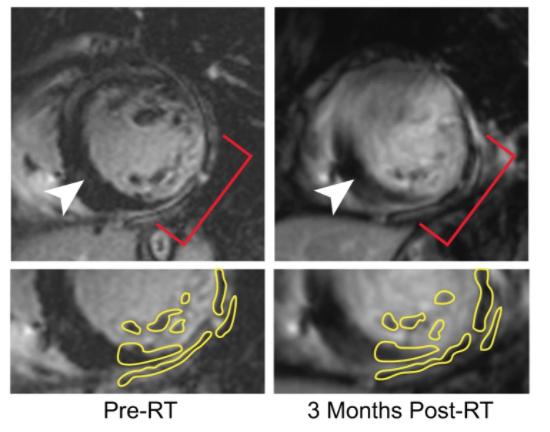 Gadolinium-enhanced MRI of a cardiac radiation therapy patient at baseline (left) and 3 months post-treatment (right). Top: the left ventricle with patchy, gadolinium-enhanced scar was transmurally targeted with a radiation ose of 25 Gy between 3 and 6 o’clock (red brackets). Nonenhanced, remote myocardium is adjacent to target region (white arrowhead). Bottom: surviving nonenhanced myocardium within the same images is visible in the targeted region at baseline and 3 months post-treatment (yellow outline). 