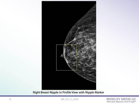 Upon call-back, a pellet marker was placed on the nipple and nipple in profile view was taken, confirming opacity seen on the prior 3D mammogram was the nipple superimposed over the anterior aspect of the breast.