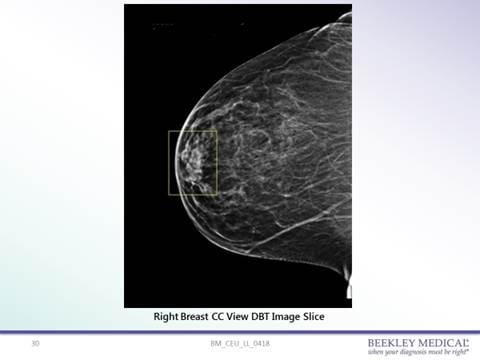 42-year-old female patient presenting a yearly routine screening mammogram in 3D. Right CC shows an opacity in the anterior aspect of the breast in the retroareolar area.
