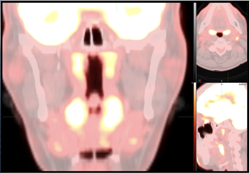 The Task Force members have recently observed an unusual imaging pattern on FDG PET/CT or FDG PET/MR that may be due to COVID-19 infection. 