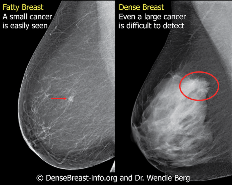 Fatty tissue and breast density may be considered in the context of many factors that affect the occurrence and detection of breast cancer