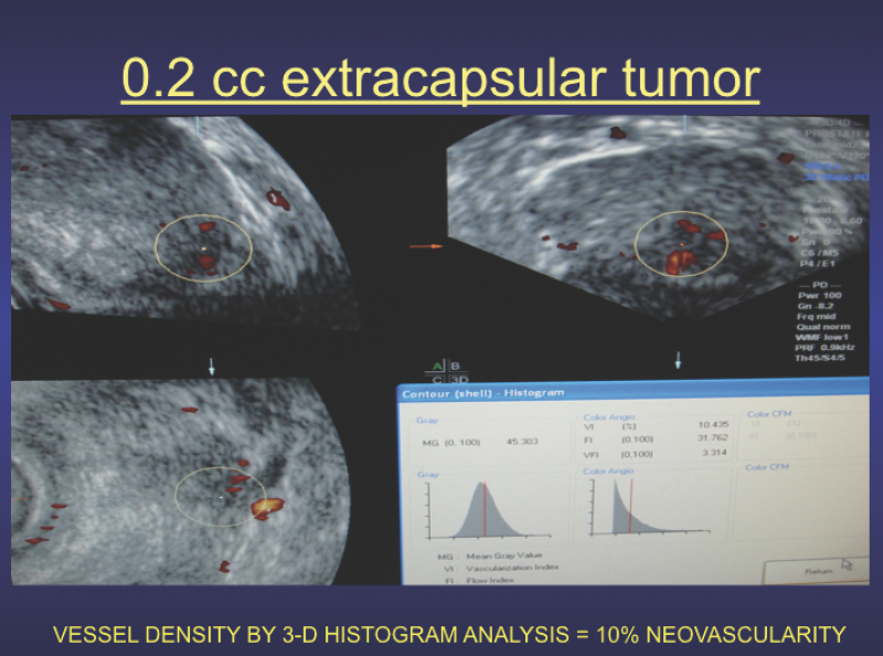 Histogram-volumetric study shows extracapsular tumor has a 10 percent malignant vessel density, which can be used as a reference measurement to assess treatment effect on serial scans