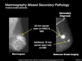 A comparison of breast cancer seen on mammography vs. molecular breast imaging (MBI).