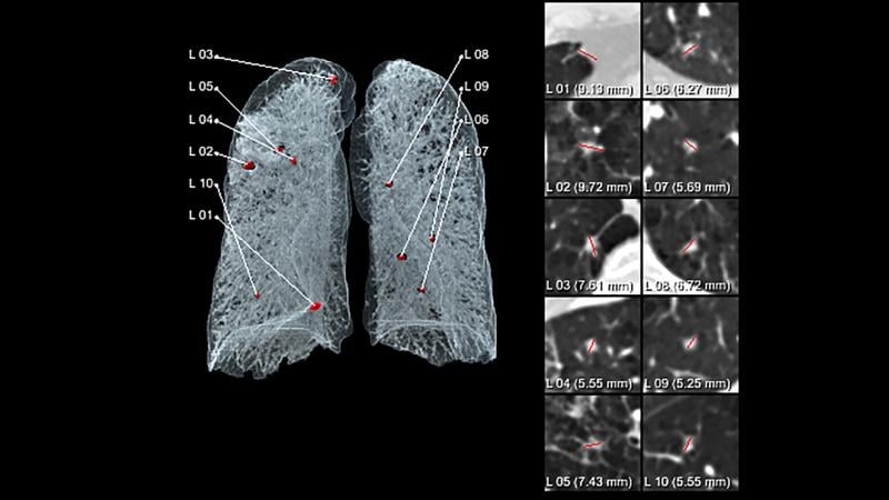 The Siemens AI-Rad Companion Chest CT provides automated visualization of chest images to support their reading and reporting.