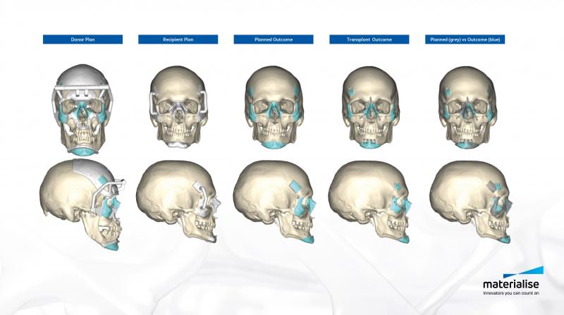 Pre-surgical planning made it possible for surgeons to virtually select and position various medical implants to predict the optimal anatomical fit.