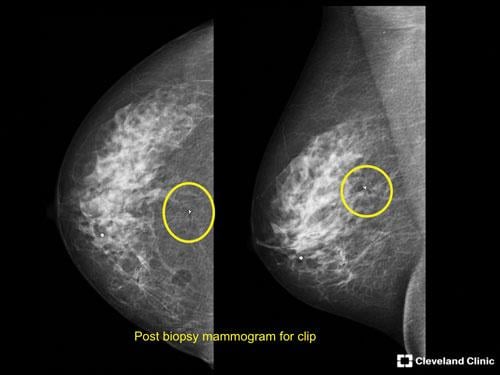 stereotactic breast imaging