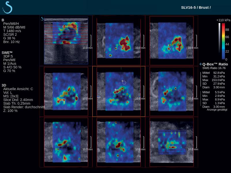 SuperSonic Imagine’s Aixplorer ultrasound system with real-time ShearWave Elastography has been proven to be a complementary tool for the management of breast cancer patients.