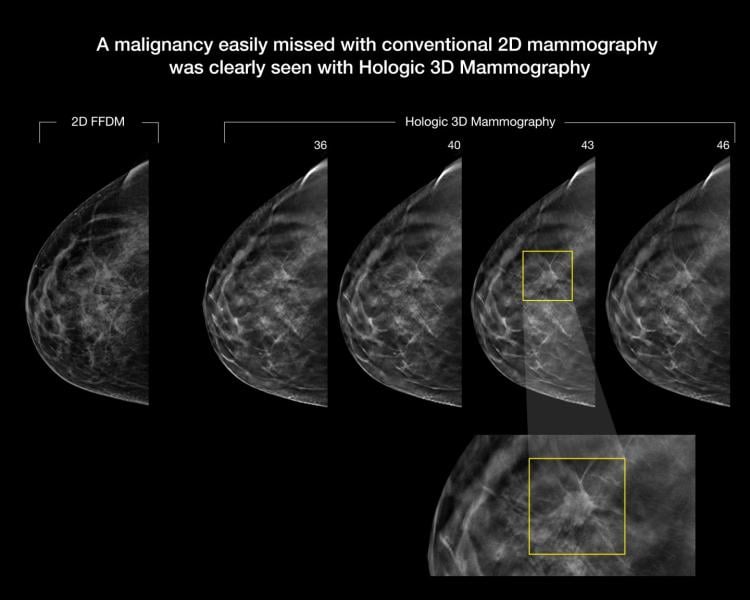 3-D Mammography Improves Cancer Detection in Dense Breasts
