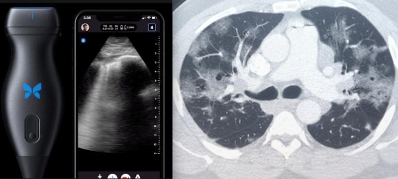 The top two videos on ITN for the year both involved medical imaging of COVID using point of care ultrasound (POCUS) and mass movement to teleradiology to enable remote working for radiologists and virtual collaboration with referring physicians. The image on the left is Butterfly's POCUS system that turns a smart phone into an ultrasound machine and the image is of COVID B-lines in the lung. The image on the right is a CT scan of COVID pneumonia. #COVID19