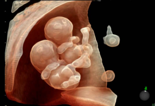 A 3D fetal ultrasound showing twins. Imaged using a GE Healthcare E10 system. Twin babies on ultrasound.