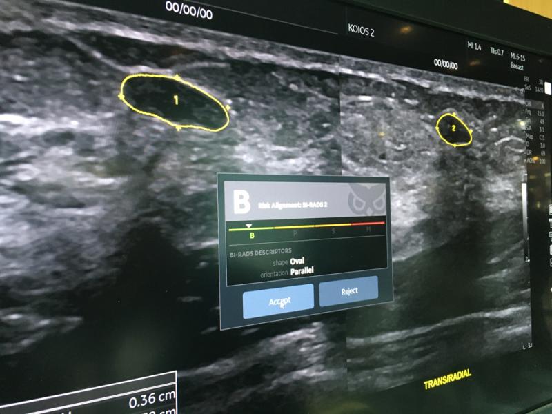 A work in progress artificial intelligence app for assessment of breast ultrasound lesions on the Logiq E10 system. 