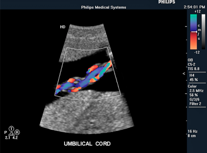 Fetal picture of ultrasound showing the Umbilical cord and the venous and arterial blood flow using color Doppler. 