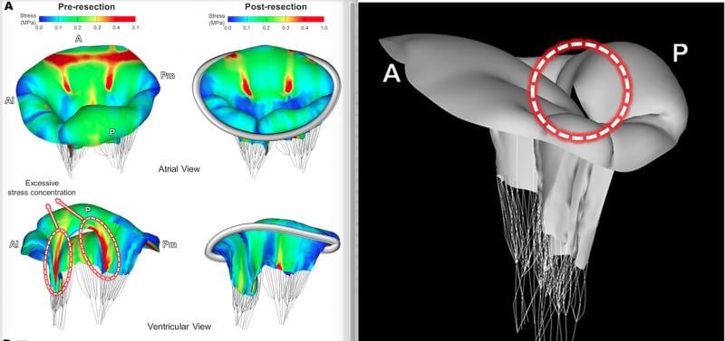 Images, or a digital twin mitral valve of a patient, created from cardiac ultrasound that were used to perform a virtual surgical procedure to test how the intervention would impact the patient prior to actually performing the procedure. The right image shows color coding for sheer stresses on the valve leaflets before and after the virtual surgery. The left image shows the model quantitation of leaflet coaptation at peak systole prior to the the virtual surgery.