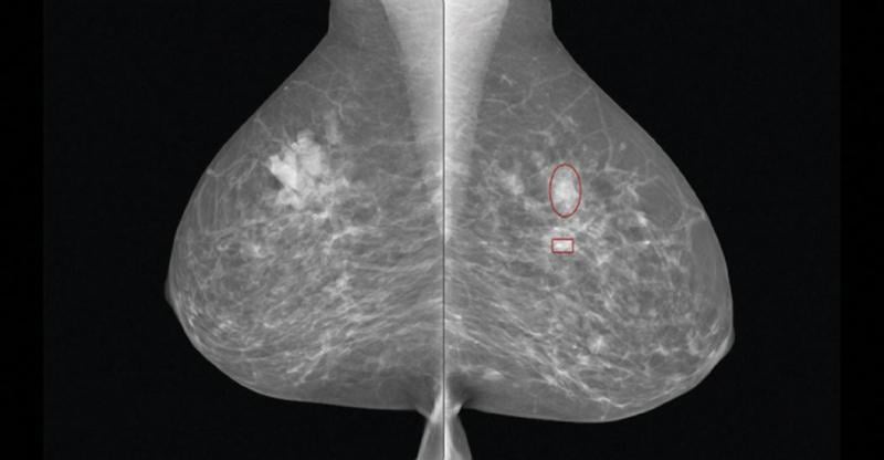 iCAD, iReveal, breast density
