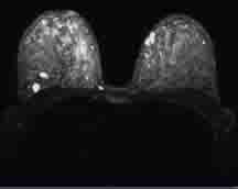 Breast MR image showing tumors that were obscured by dense breast issue on a mammogram.