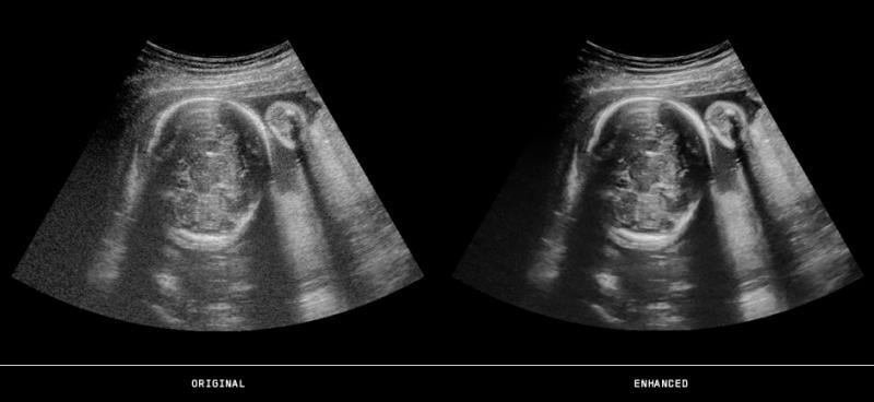 Fetal ultrasound showing image enhancement with the ContextVision US PLUSView image reconstruction software. Fetal imaging is referred to by many names, including pregnancy sonograms, pregnancy ultrasound, endovaginal ultrasound, obstetric ultrasound, OB ultrasound, baby ultrasound, prenatal ultrasound. Fetal heart ultrasound is also called baby echo or prenatal echo. 