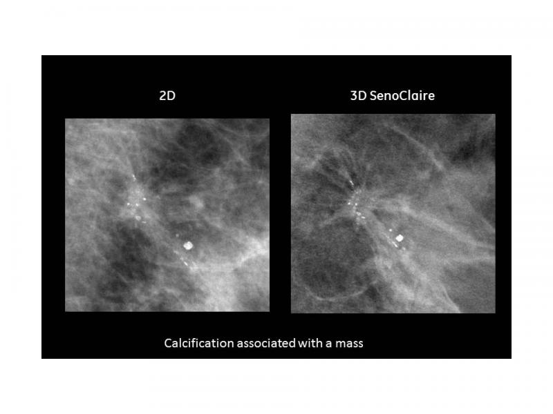 GE, SenoClaire, mammography, 3-D breast imaging, tomosynthesis, dense breast tissue