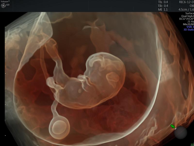 3D-4D picture of ultrasound depicting a fetus with a GE Volusion E10 system