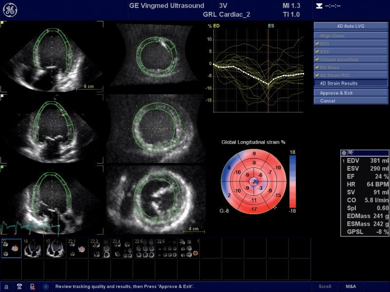 cardio-oncology, echo strain assessment, GE echo, GE ultrasound, strain imaging