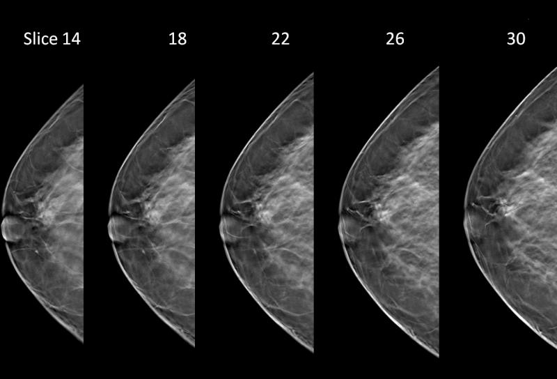 tomosynthesis, 3D mammography