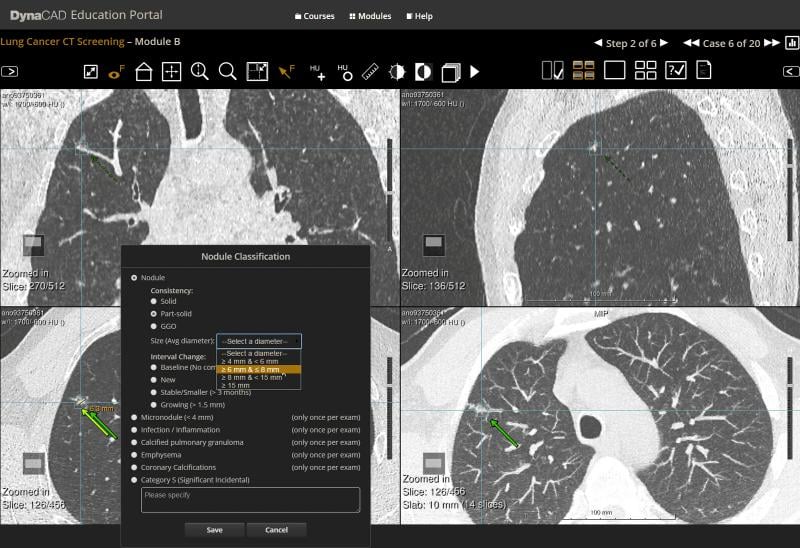 low-dose CT, LDCT, lung cancer, screening, nonsolid nodules, Mount Sinai