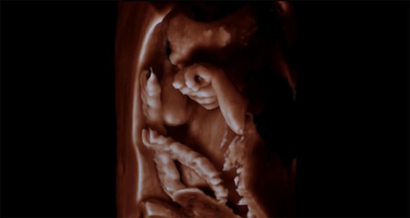 Fetus with hand in front of its face and umbilical cord seen using 3-D ultrasound. Images using Philips TrueVue imaging technology. This is a baby ultrasound, also referred to as fetal ultrasound, OB ultrasound or prenatal ultrasound.