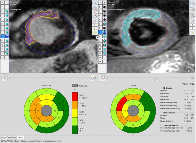 Pie Medical’s cardiac MRI perfusion functional imaging CAAS MRV software for quantification.