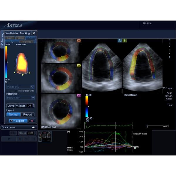 cardio-oncology, Toshiba echo, toshiba ultrasound