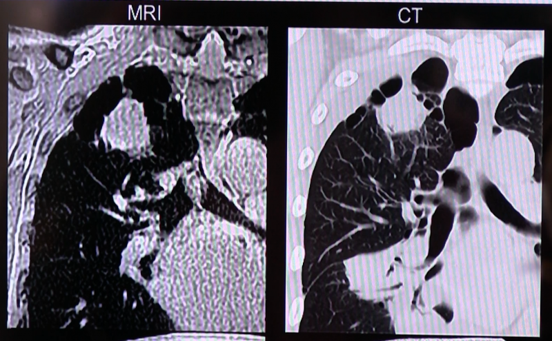 Toshiba's new ultrashort echo time dedicated pulmonary MRI protocol allows lung imaging to avoid the need for CT. This image shows a comparison of the new MRI imaging protocol with the same view from the patient's CT scan.
