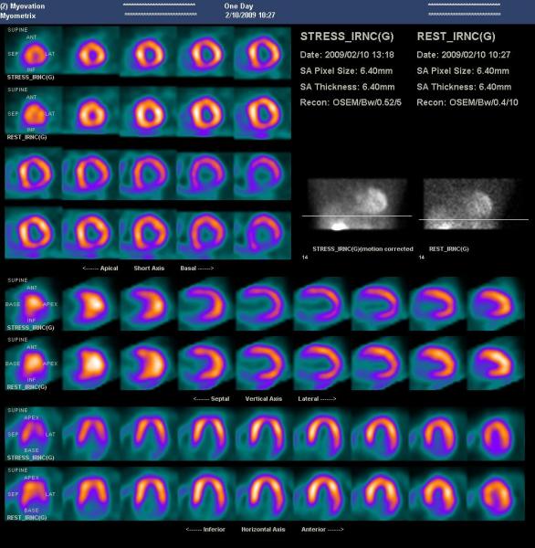 An example of a SPECT scan of the same patient using traditional full-time image acquisition.