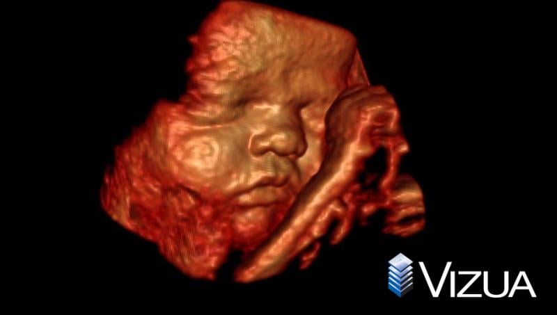 A 3-D ultrasound of a baby rendered with advanced visualization software from Vizua.