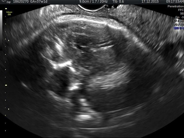 Zika virus infected fetus on ultrasound, showing calcifications in the brain and microcephaly. This is a baby ultrasound, also referred to as fetal ultrasound or prenatal ultrasound.