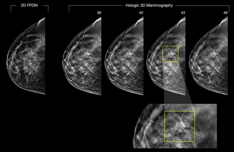 2-D and 3-D digital breast images
