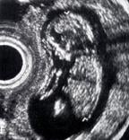 1978: The beginning of universal usage of ultrasounds to monitor fetal development starting from weeks eight for early detection of any (genetic, chromosome) deformations, and to identify its gender.