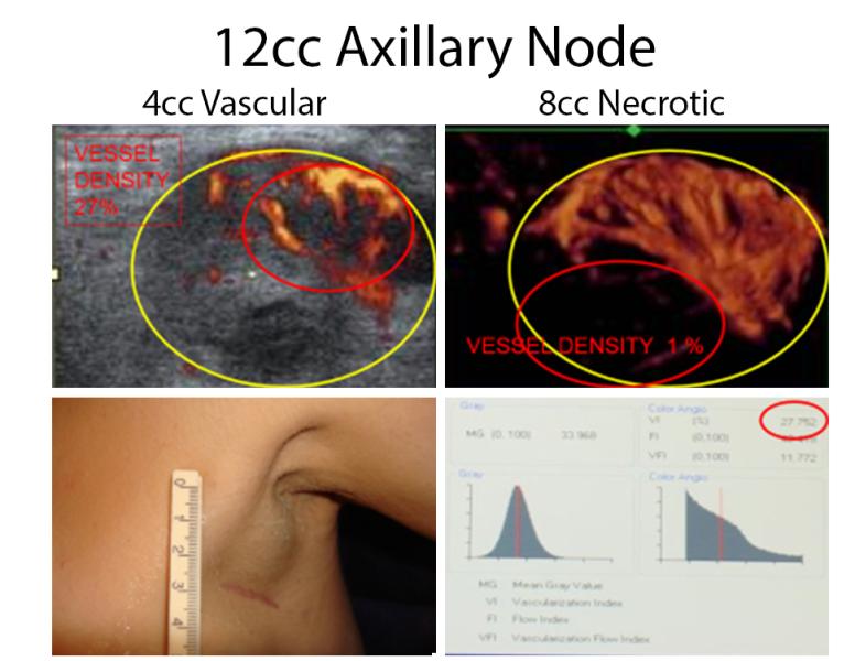 Figure 3.  Mixed solid/necrotic axillary lymph node-vessel density allows targeting of active disease.