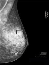 SecondLook Premier software from iCAD marks potential mass (oval) and calcifications (rectangle) on left breast with dense tissue.Breast Density Assessment and Fibroglandular Densities 