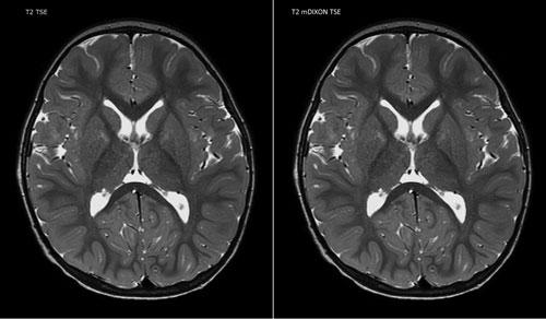 An example of a Philip's mDixon MRI brain scan.