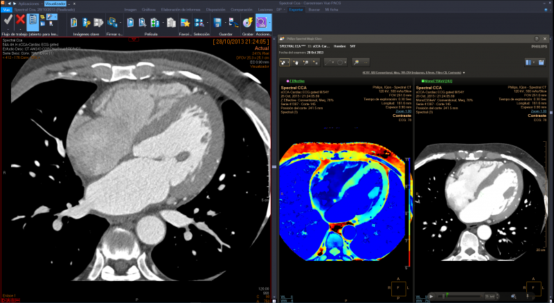 Philips integrated the IntelliSpace Portal advanced applications with the Philips diagnostic viewer (from Carestream)  creating a combined radiology diagnostic workspace.