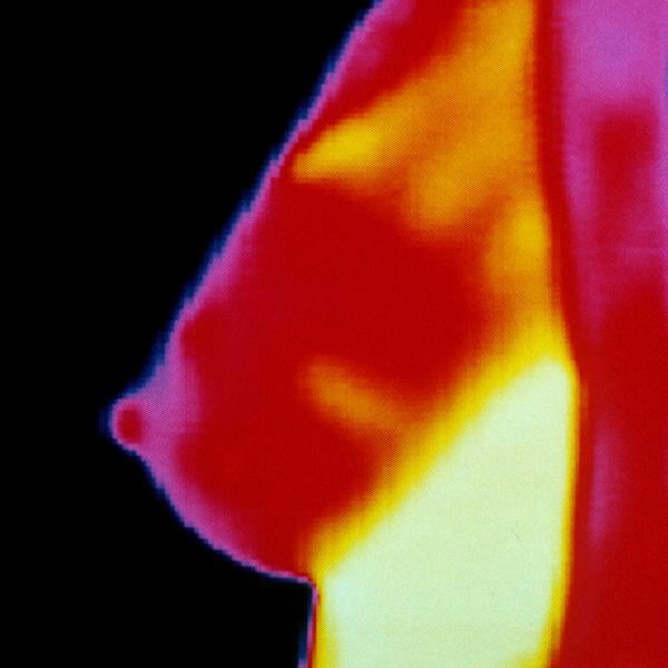 FDA Warns Thermograms Are No Substitute for Mammograms